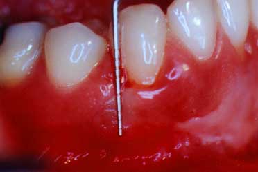 periodontal probe outside pocket