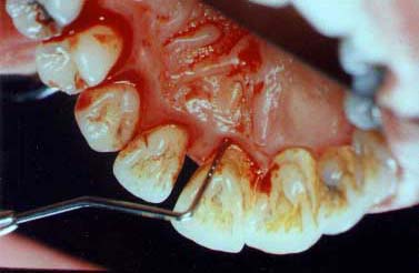 5mm periodontal pocket